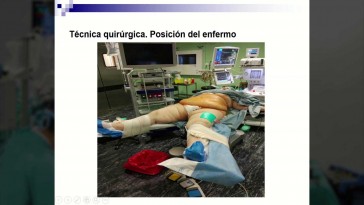 Colecistectomía laparoscópica programada: Indicaciones, anatomía local y técnica quirúrgica