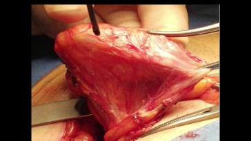 Hernioplastia inguinal: Anatomía local y técnica quirúrgica