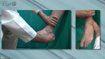 Diagnóstico de las lesiones ligamentosas externas