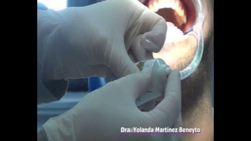 Aplicación de recaldent en consulta dental
