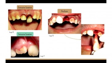 traumatic dental injuries_rico