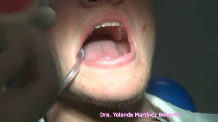 Fluorizacion_topica_en_el_gabinete_dental