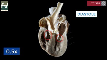 Dilated Cardiomyopathy in the Dog