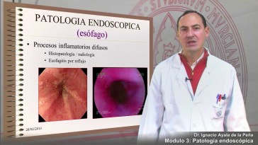 modulo 3-1: Patología Endoscópica I (esófago)